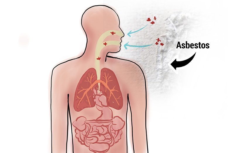 symptome du cancer broncho pulmonaire