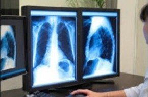 Mesothelioma Xray