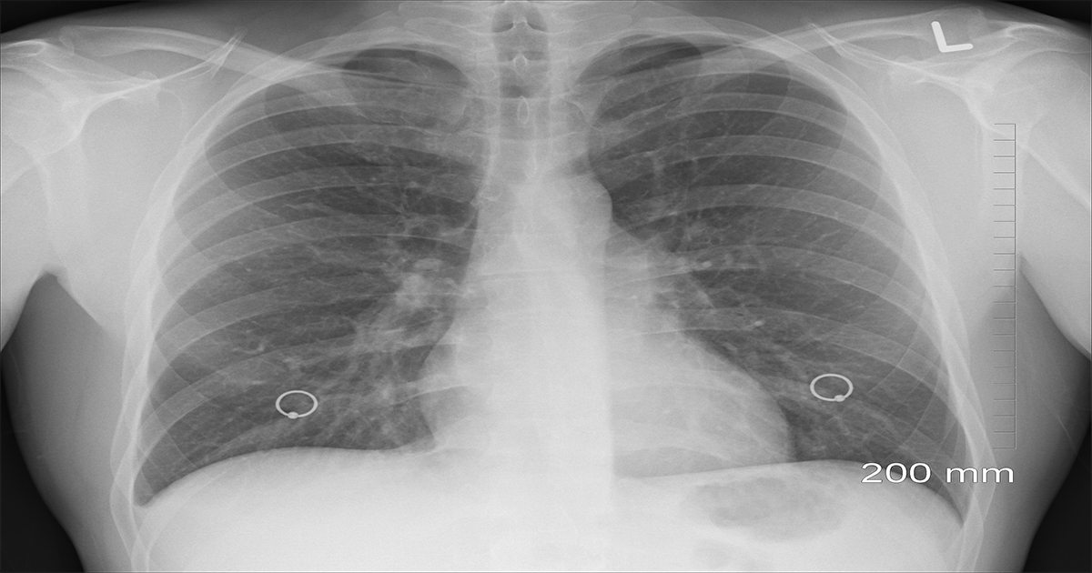 Pneumonia and Mesothelioma