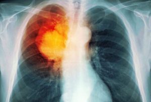 X-ray result of Lungs with Cancer