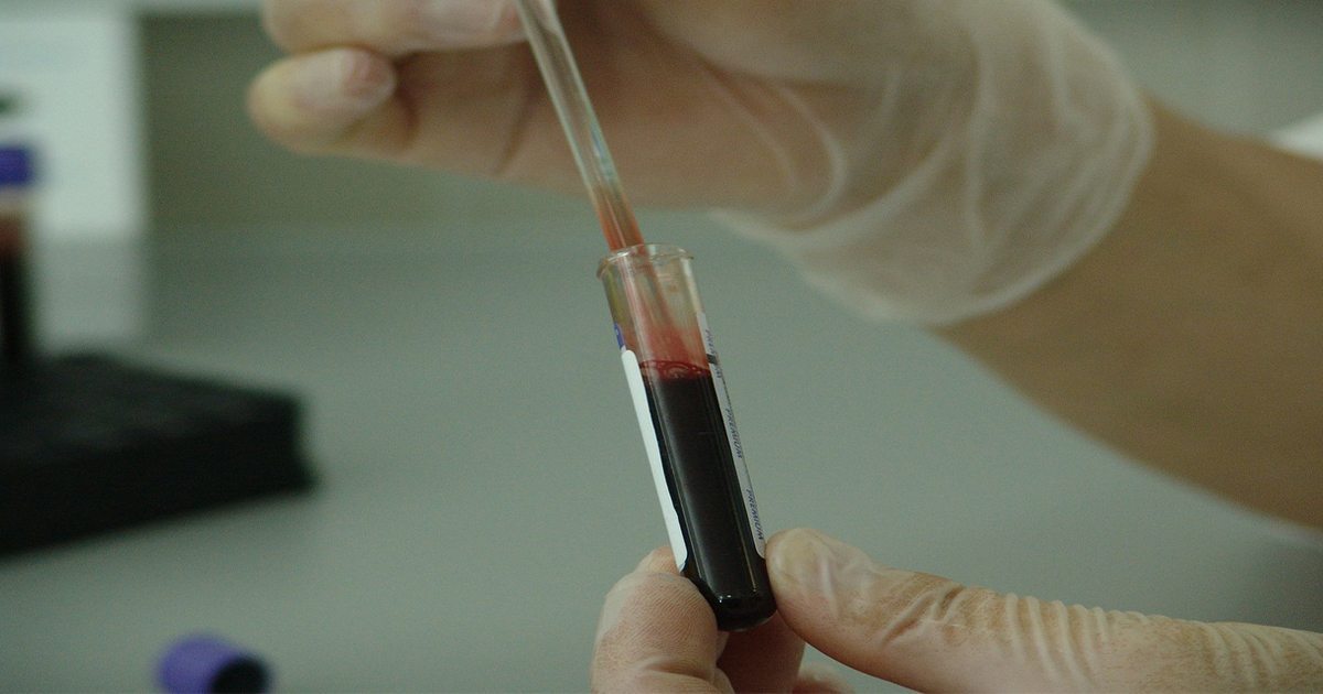 Blood Samples In Monitoring Lung Cancer