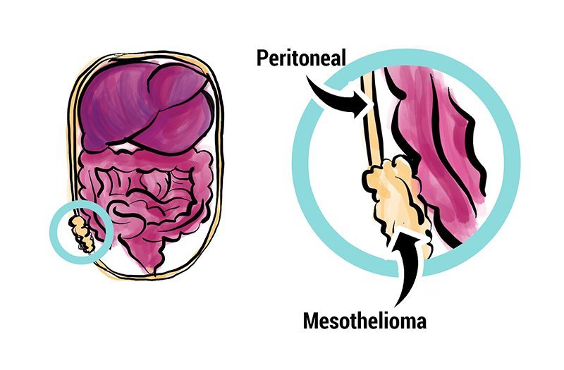 How does peritoneal mesothelioma develop