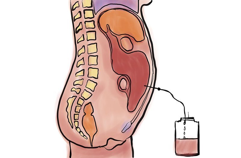 peritoneum Mesothelioma Diagnosis