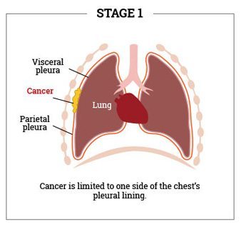 what is stage 1b cervical cancer