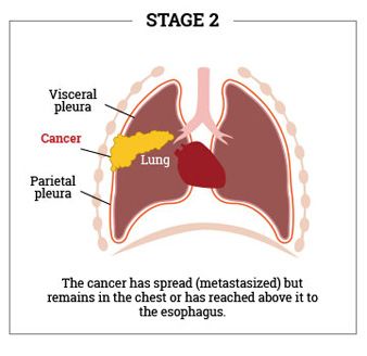 Stage-2-mesothelioma