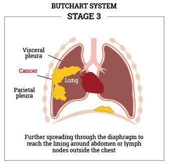 Stage-3-Butchart-mesothelioma