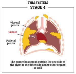 Mesothelioma Cancer Help: The Complete Guide To Mesothelioma Cancer