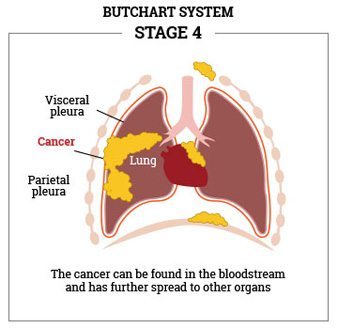 advanced peritoneal mesothelioma