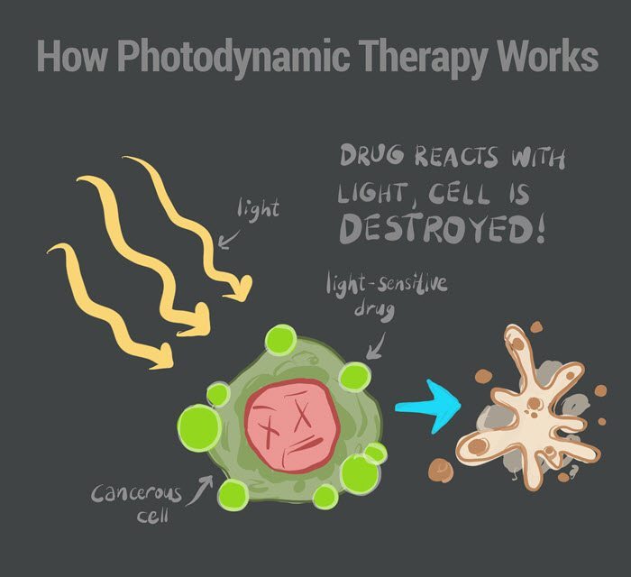 How Photodynamic Therapy Works