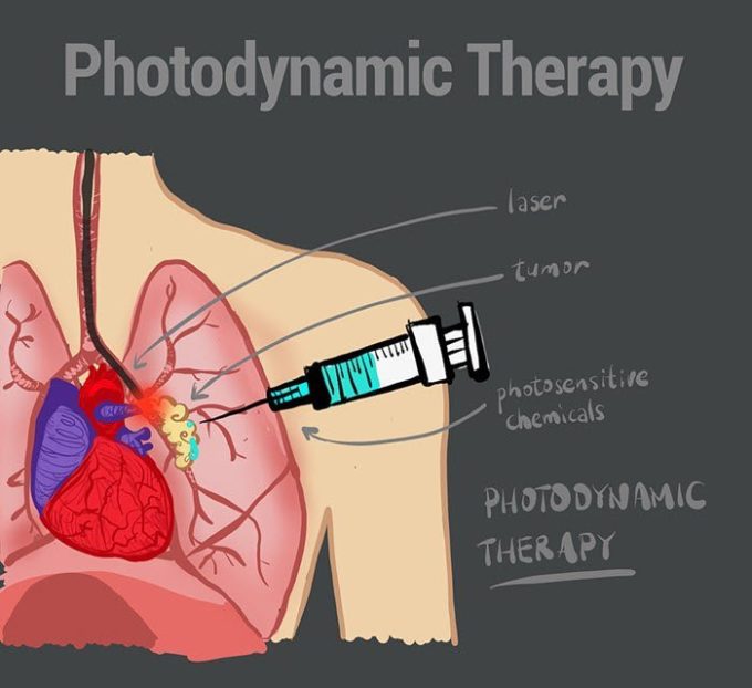 Photodynamic Therapy Mesothelioma