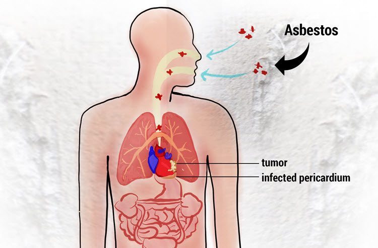 Pericardial Mesothelioma Mesothelioma Affecting The Heart