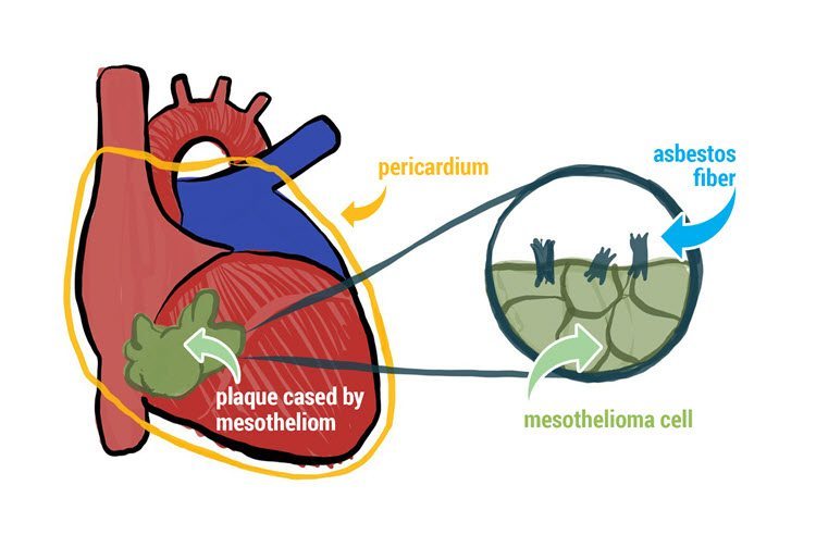 How does pericardial mesothelioma develop