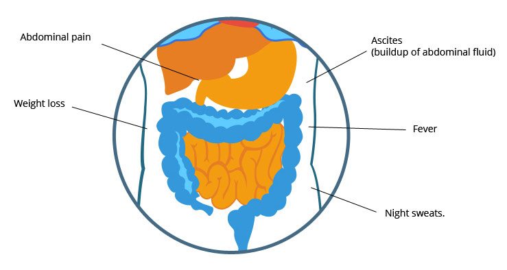 can crohns lead to cancer