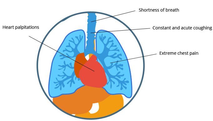 mesothelioma hx icd 10