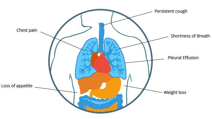 Pleural Symptoms (Lungs)