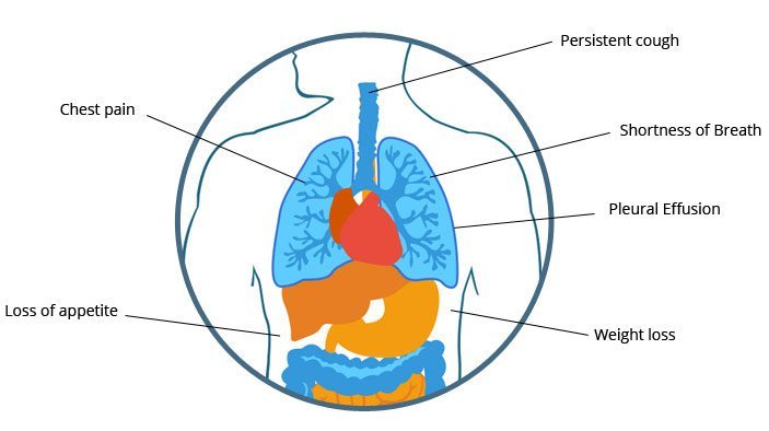 why does mesothelioma cause pleural effusion