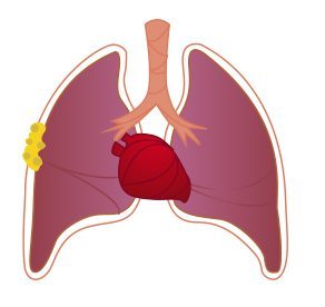 Stage I (Localized) Pleural Mesothelioma