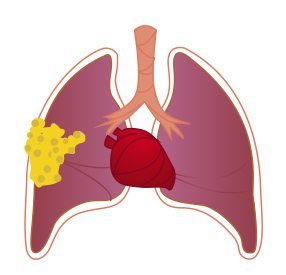 Stage 2 (Advanced) Pleural Mesothelioma