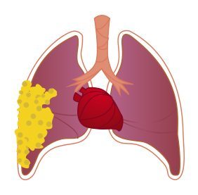 Stage III (Advanced) Pleural Mesothelioma