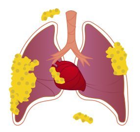 Stage IV (Advanced) Pleural Mesothelioma