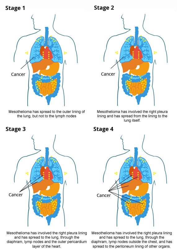 Cancer Stages 1 to 4