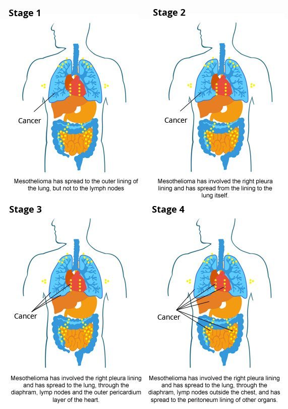 Mesothelioma Life Expectancy  How Long Do Patients Live?