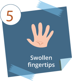05-mesothelioma-symptoms-swollen-finger-tips