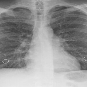 Asbestos: Your Complete Guide To Fibers, Exposure & Mesothelioma