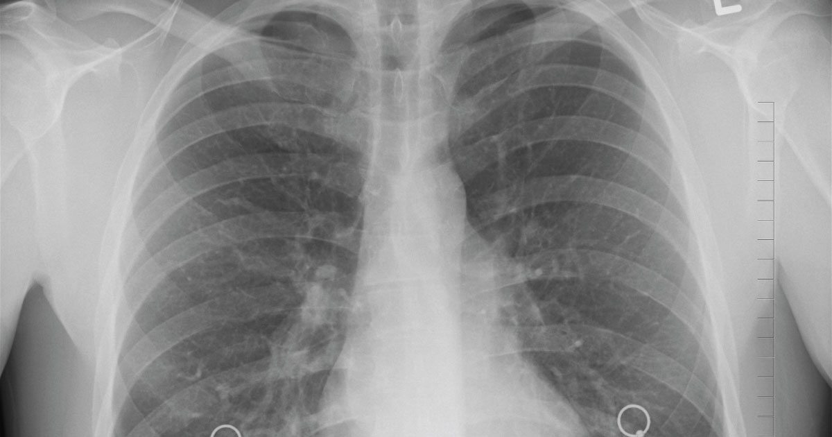 mesothelioma pediatric