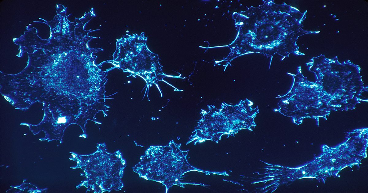 how to stage adenocarcinoma of the lung