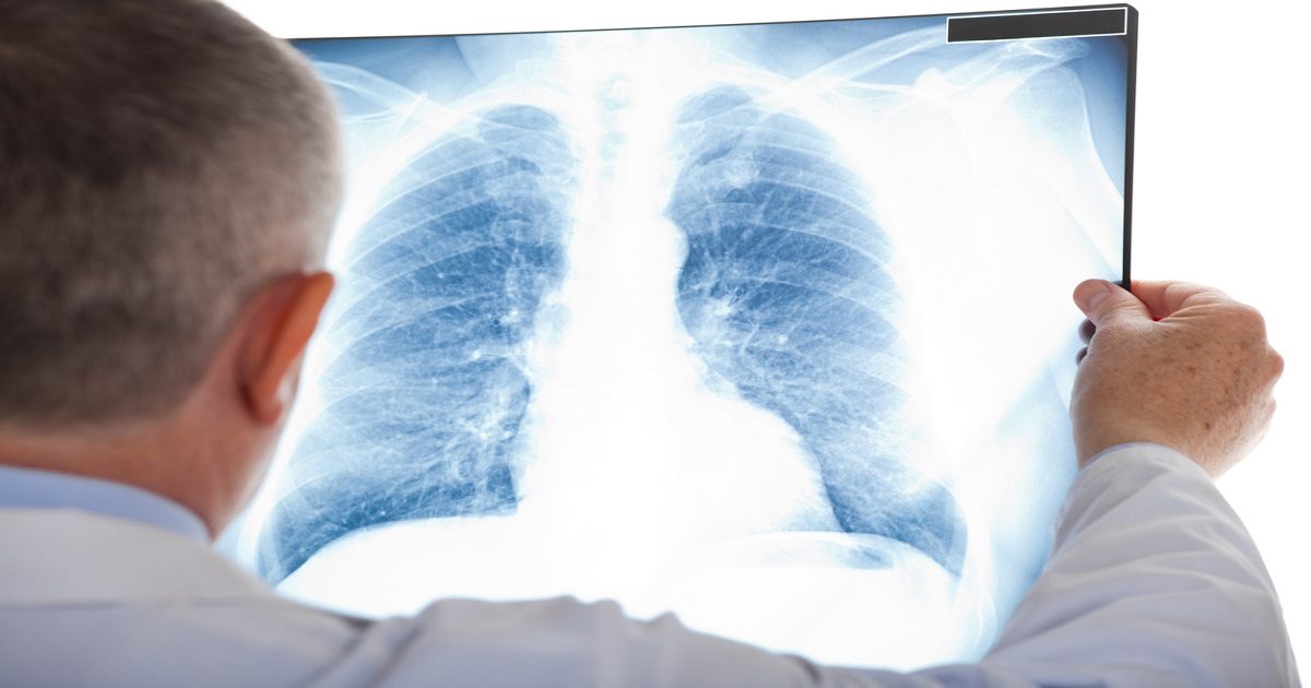 Molecule Determines Lung Cancer Cells - Mesothelioma Cells