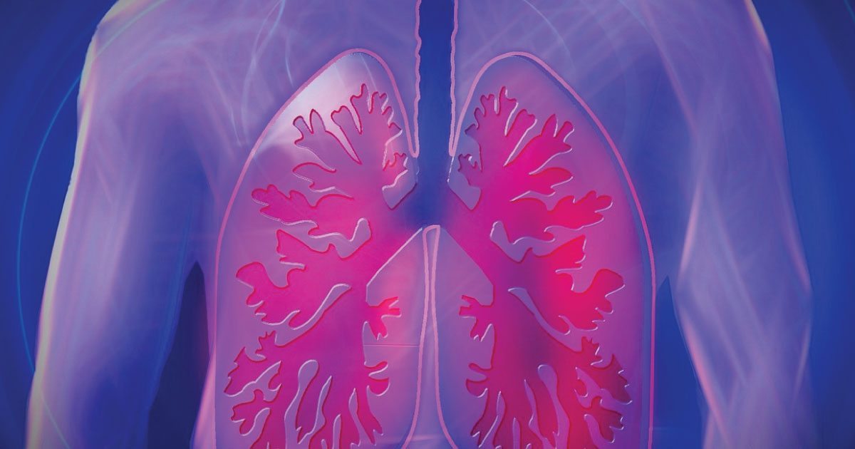 New Way to Treat KRAS Lung Cancer