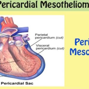 Pericardial Mesothelioma
