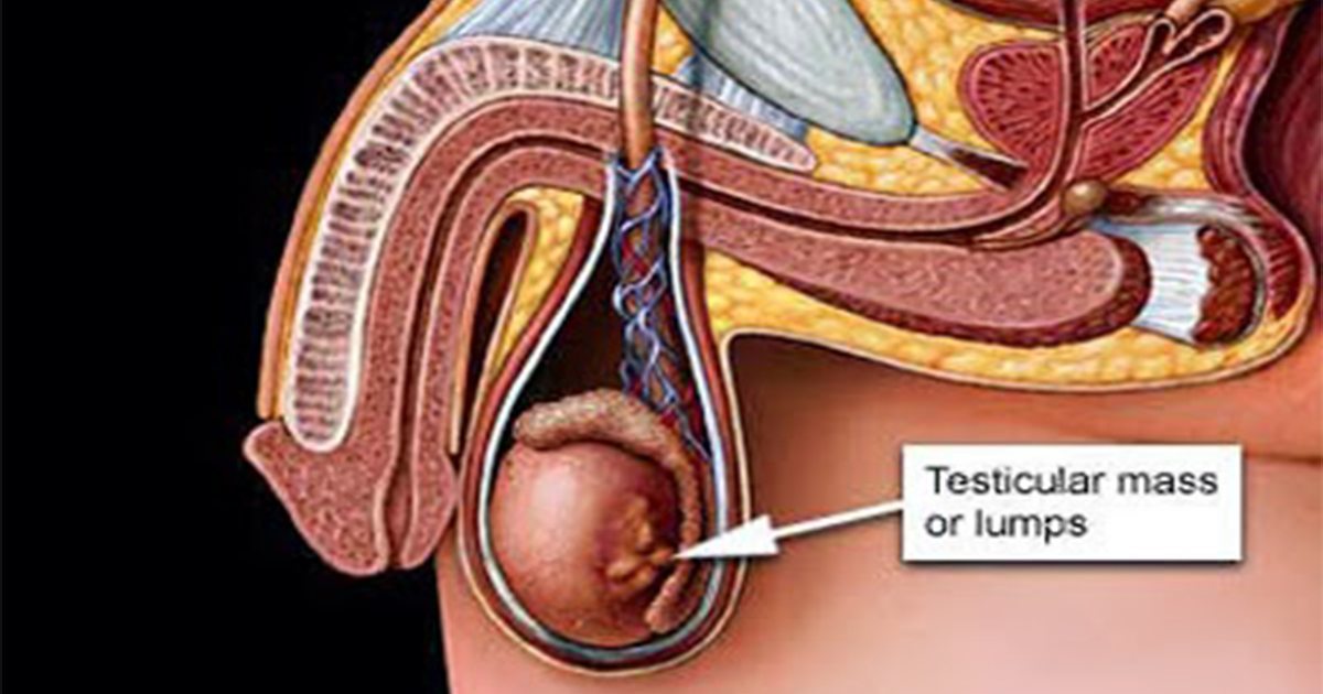 Mesothelioma of the Tunica Vaginalis Testis