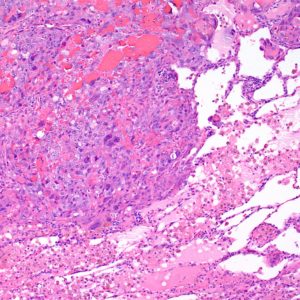 Pleural Mesothelioma