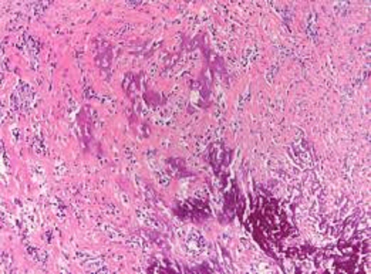 peritoneal mesothelioma pathology outlines