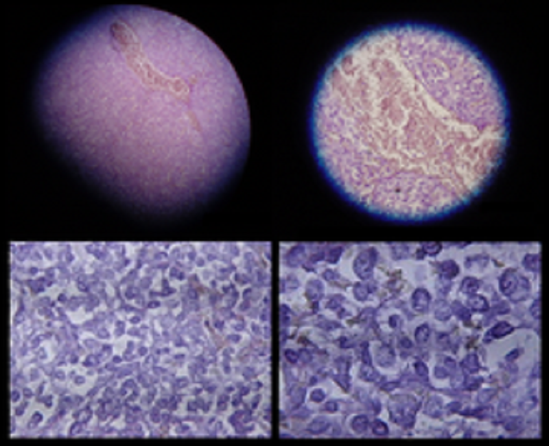 mesothelioma ihc marker