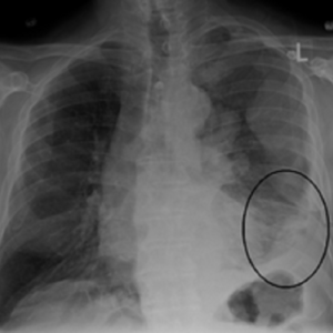 Malignant pleural mesothelioma