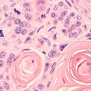 Sarcomatoid Mesothelioma