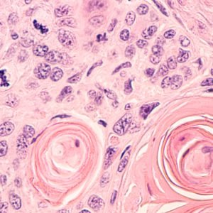 Sarcomatoid Mesothelioma