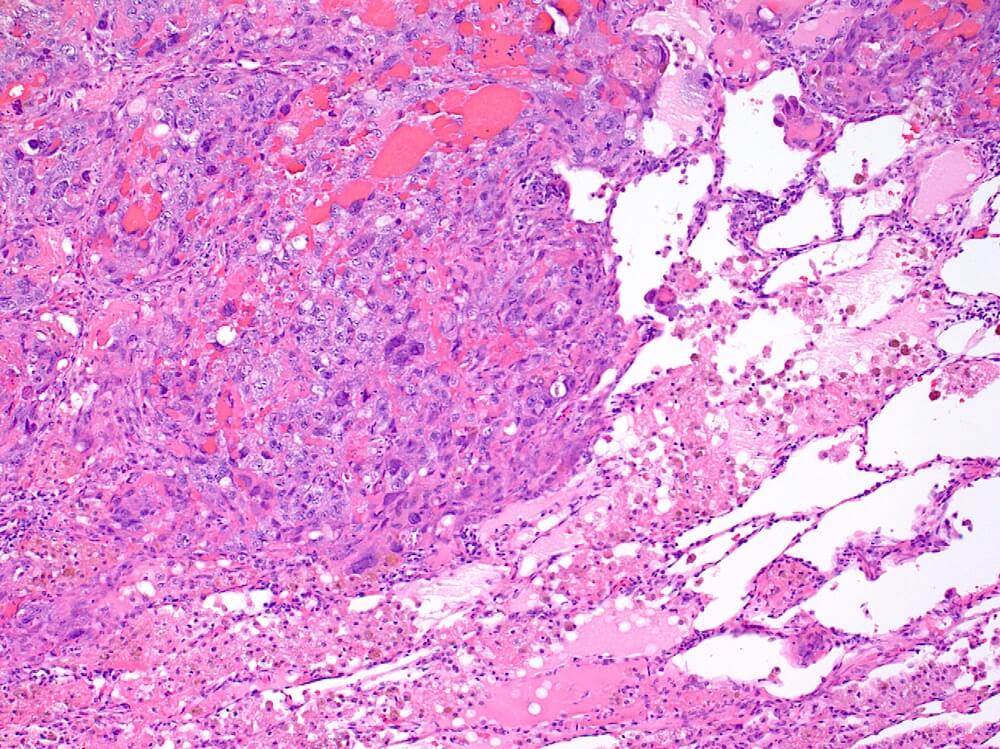 metastatic mesothelioma