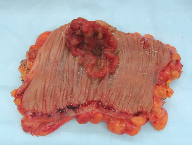 how long can you live with squamous cell carcinoma