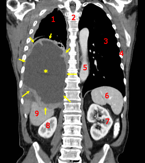 does thyroid cancer metastasis to the brain